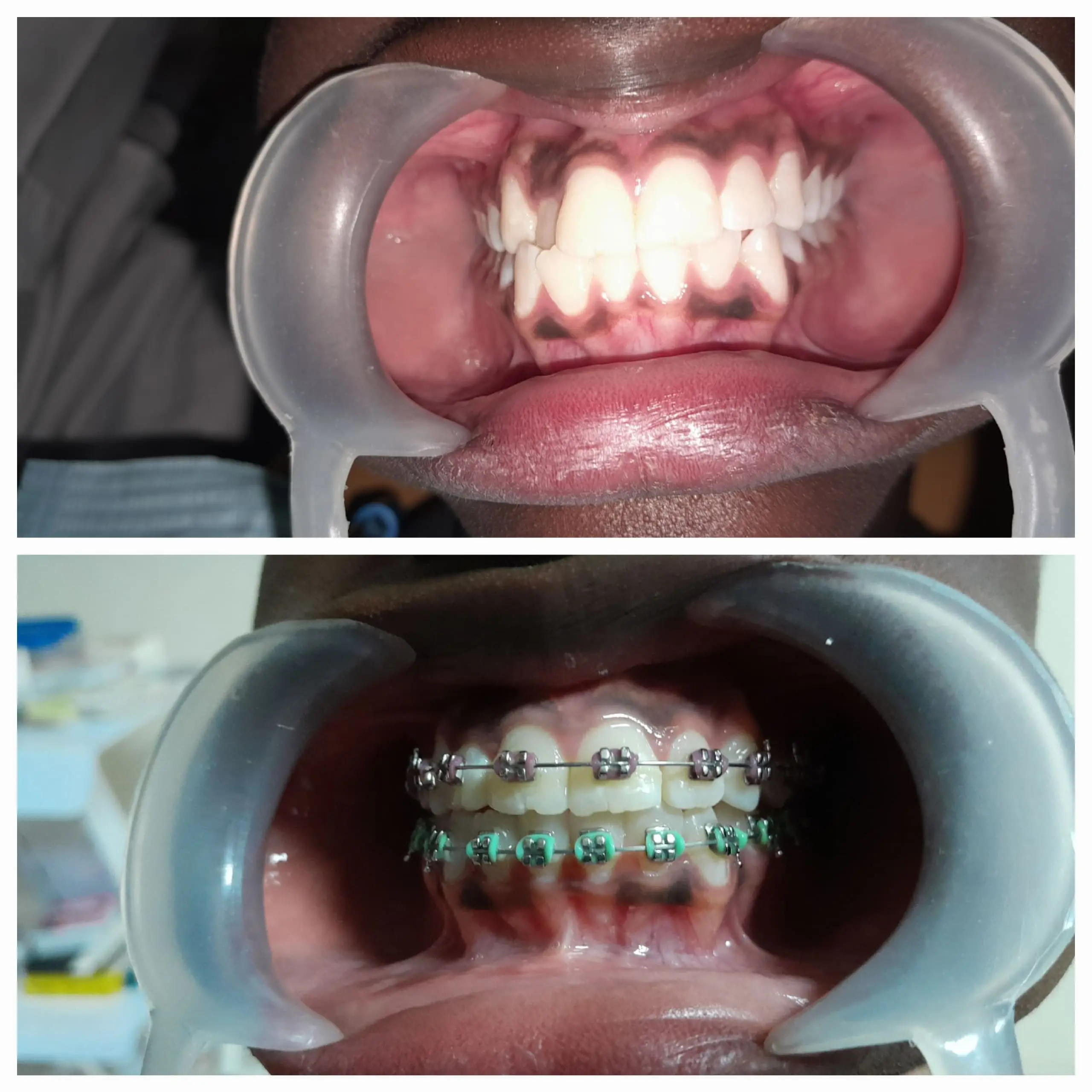 Braces done at Sterling Dental Clinic